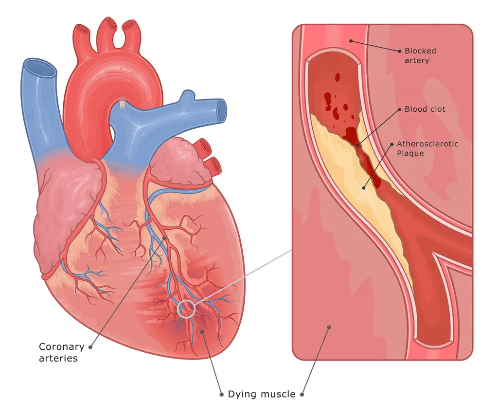Heart Attack Symptoms & Treatment | Vital Heart & Vein