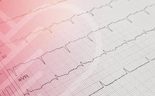 Irregular Heartbeat