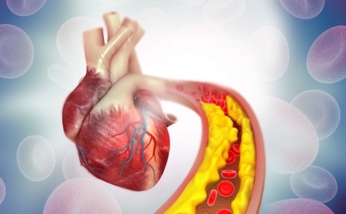 Does High Cholesterol Cause Heart Disease?