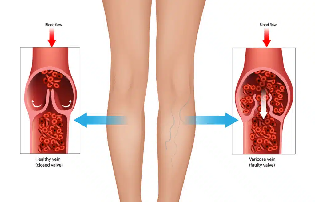 Varicose Vein Blood Flow